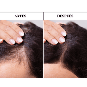 Antes y después tratamiento anticaida para la caída del cabello, pelo fuerte y sano