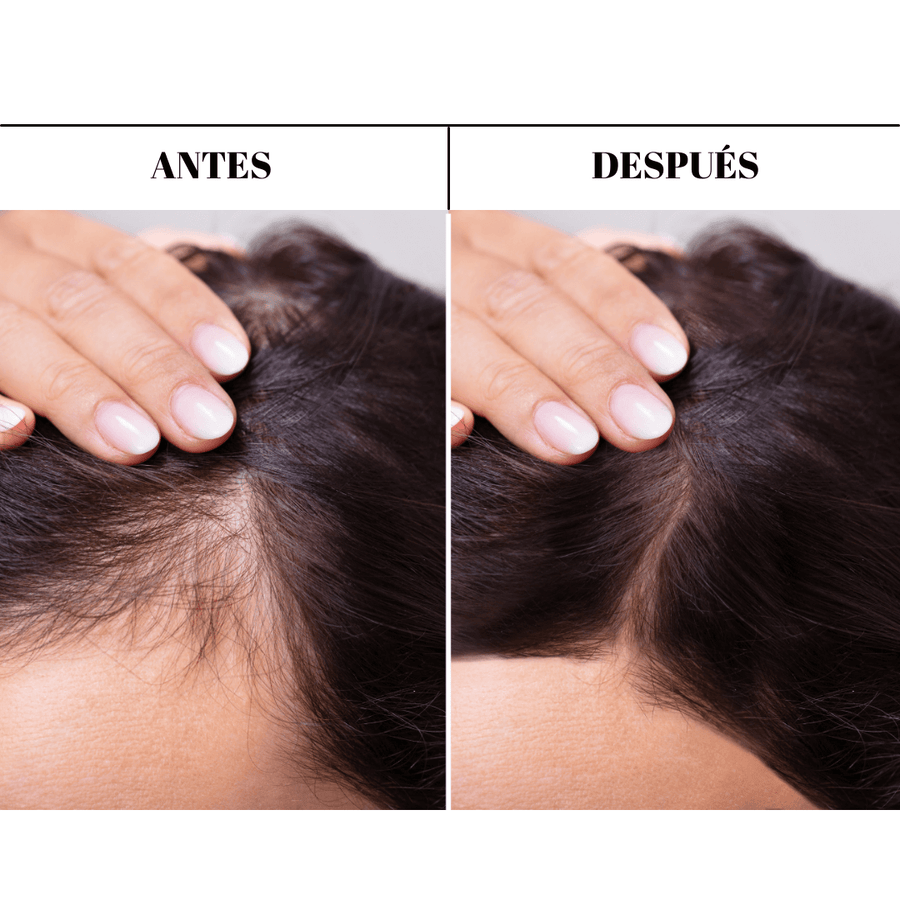 Antes y después tratamiento anticaida para la caída del cabello, pelo fuerte y sano
